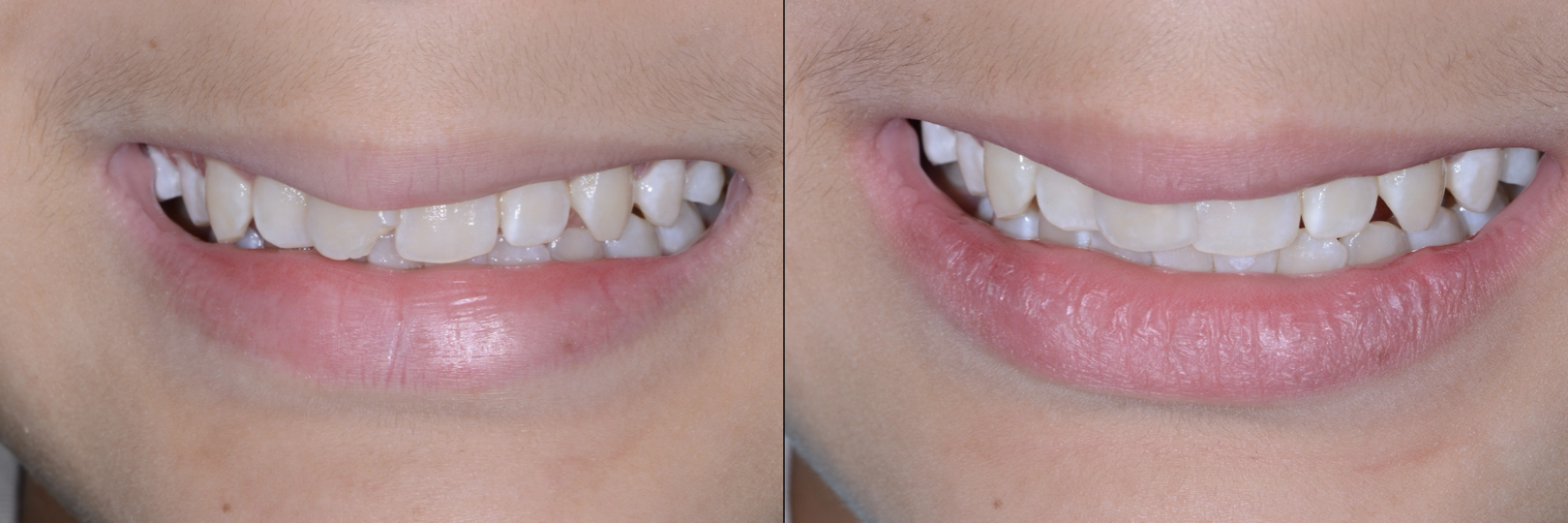 Before and After Image: Composite Bonding - front