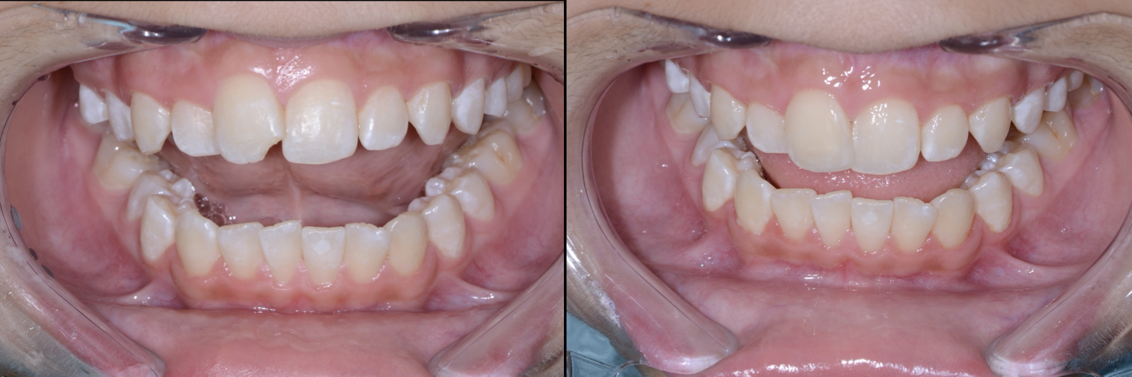 Before and After Image: Composite Bonding - front
