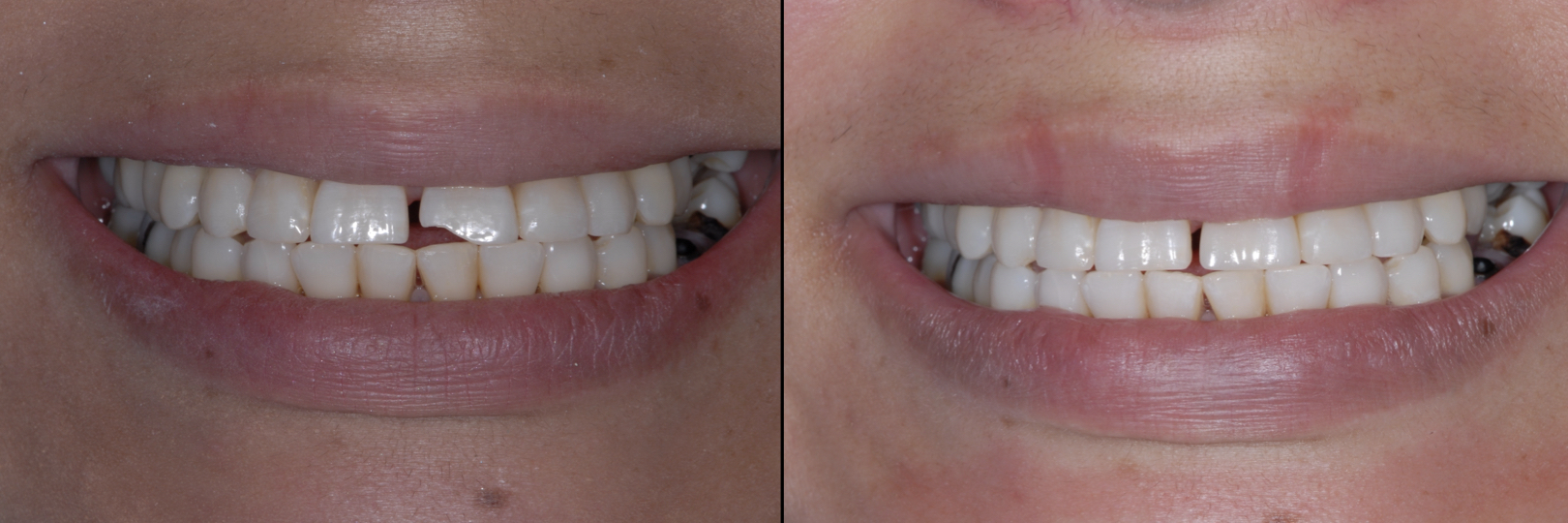 Before and After Image: Composite Bonding - front