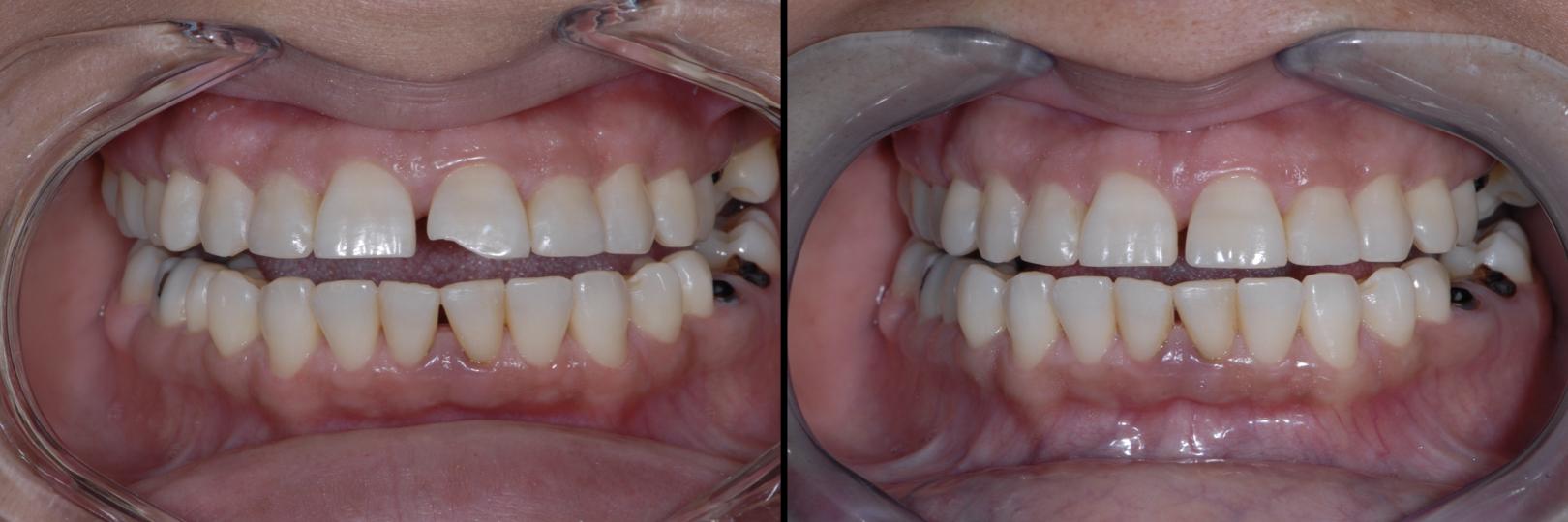Before and After Image: Composite Bonding - front