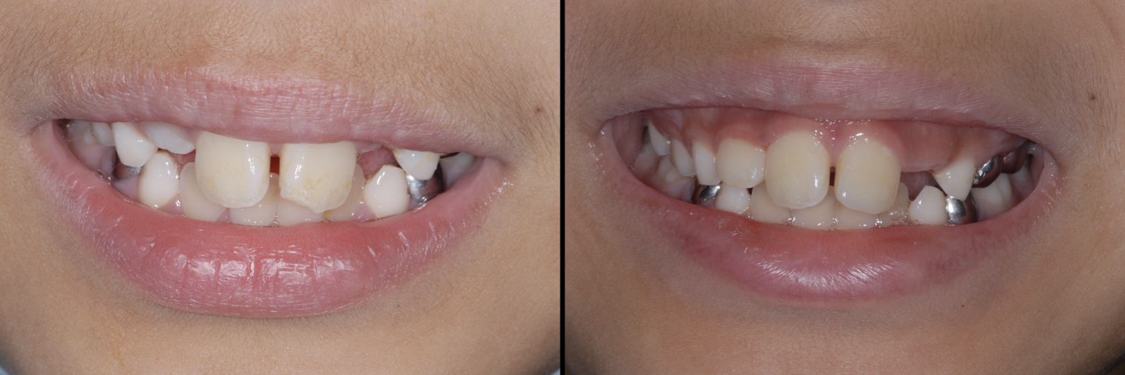 Before and After Image: Composite Bonding - front