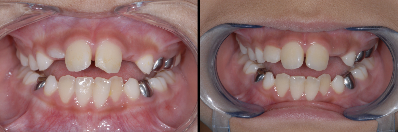 Before and After Image: Composite Bonding - front