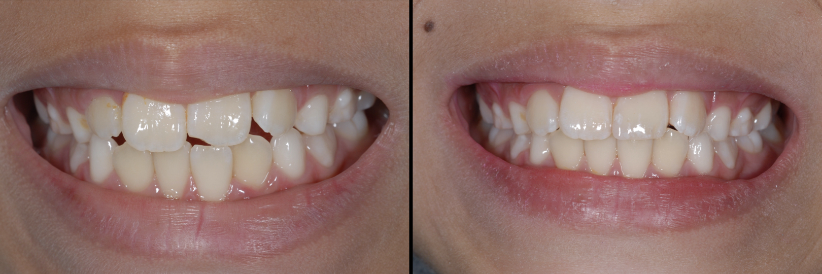 Before and After Image: Composite Bonding - front