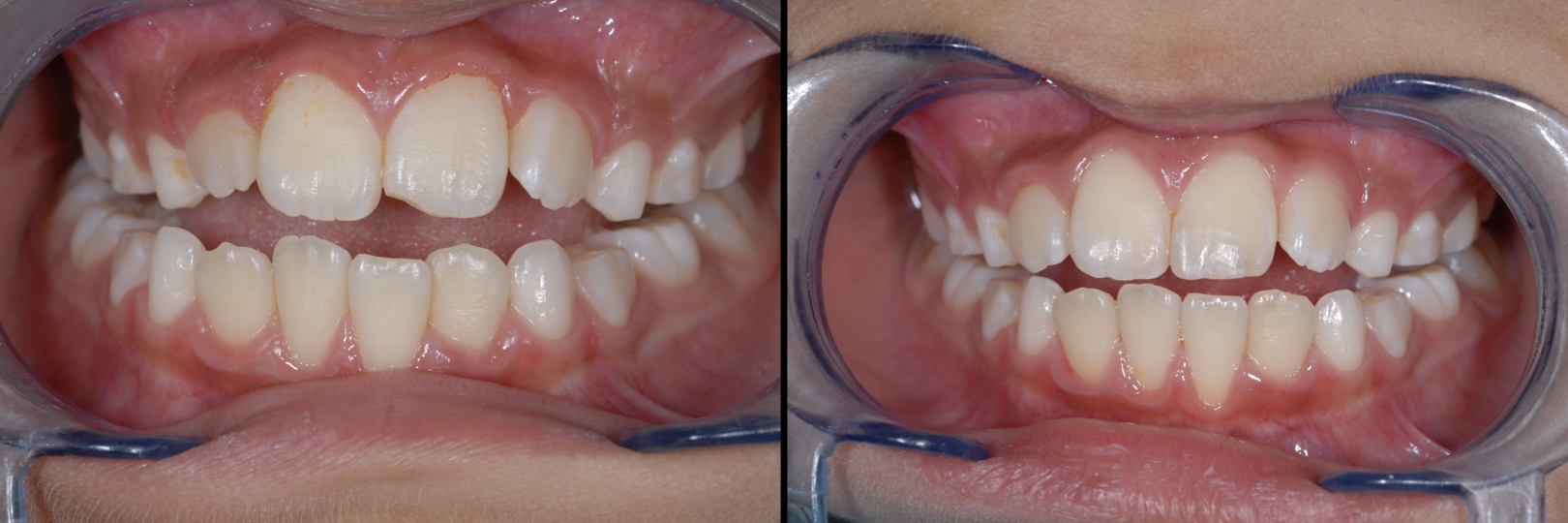 Before and After Image: Composite Bonding - front