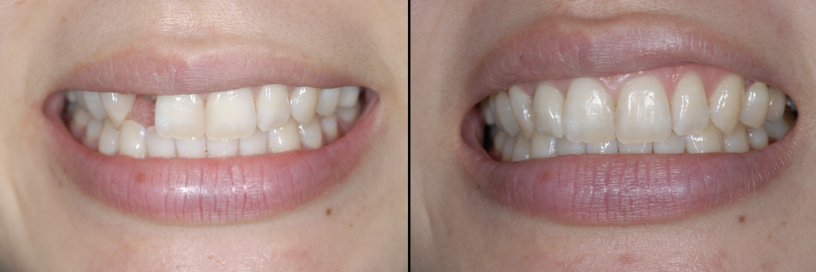 Before and After Image: Dental Implant - front