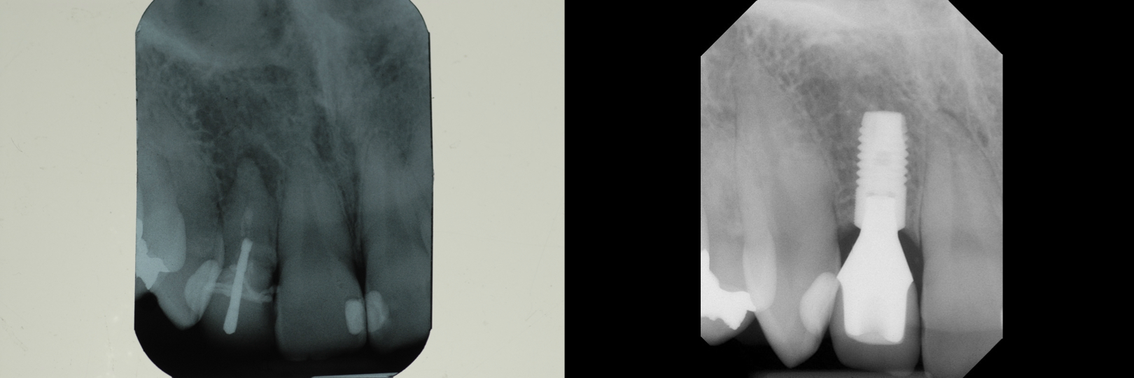 Before and After Image: Dental Implant - front