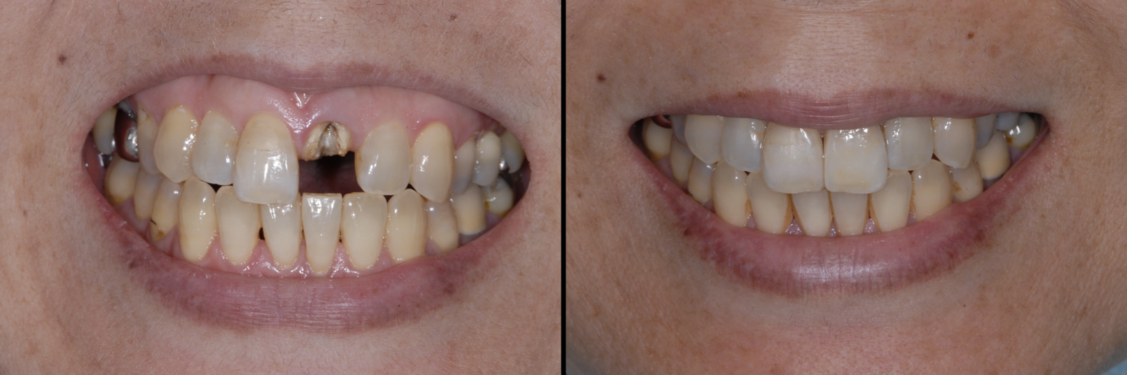 Before and After Image: Dental Implant - front