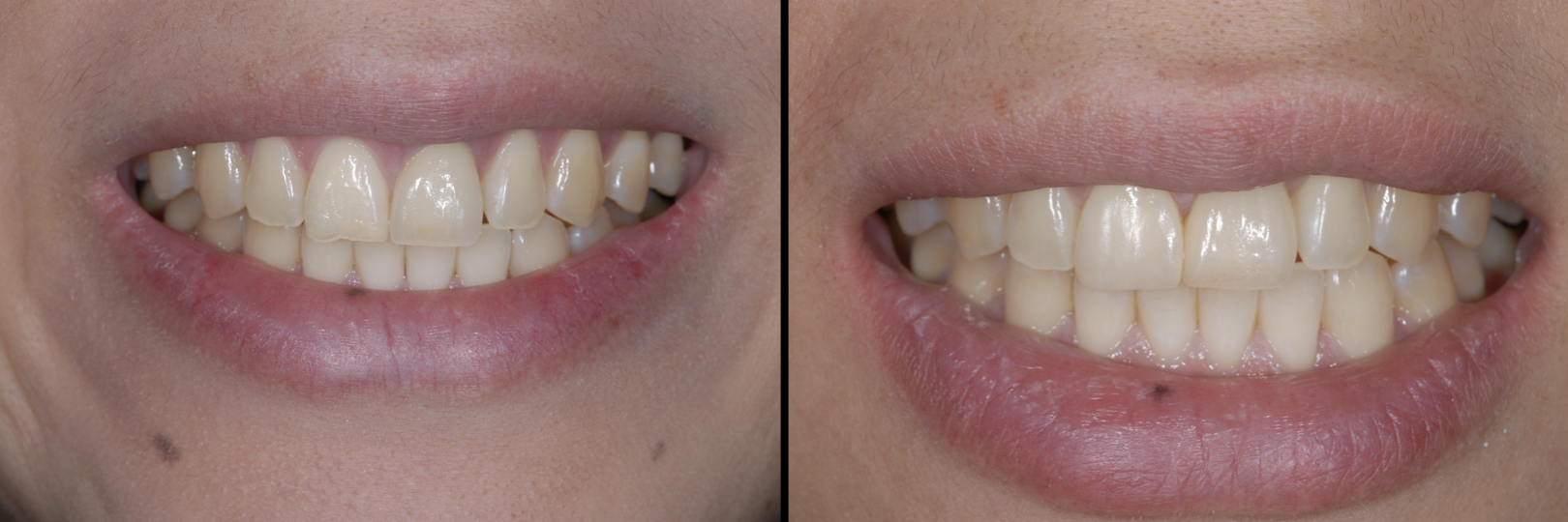 Before and After Image: Dental Implant and Composite - front