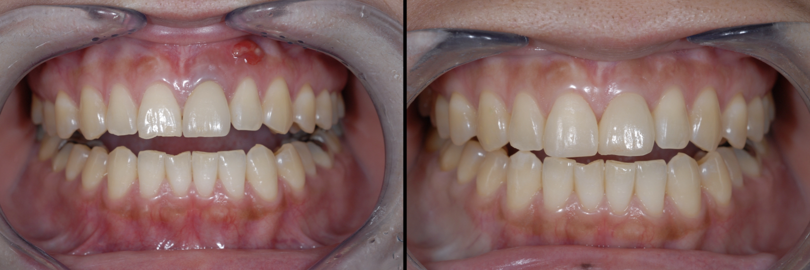 Before and After Image: Dental Implant and Composite - front