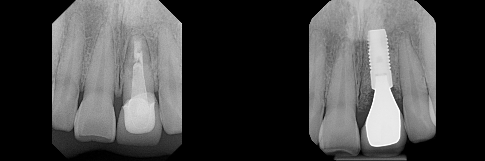 Before and After Image: Dental Implant and Composite - front