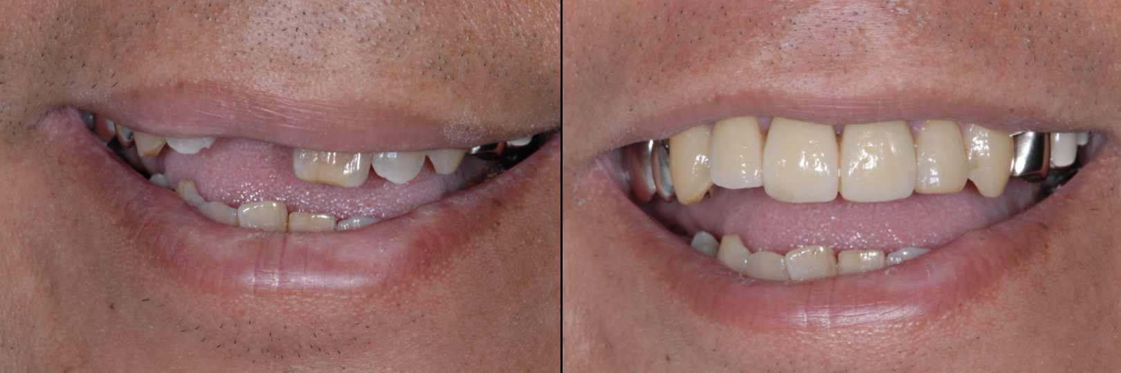 Before and After Image: Zirconia Bridge - front