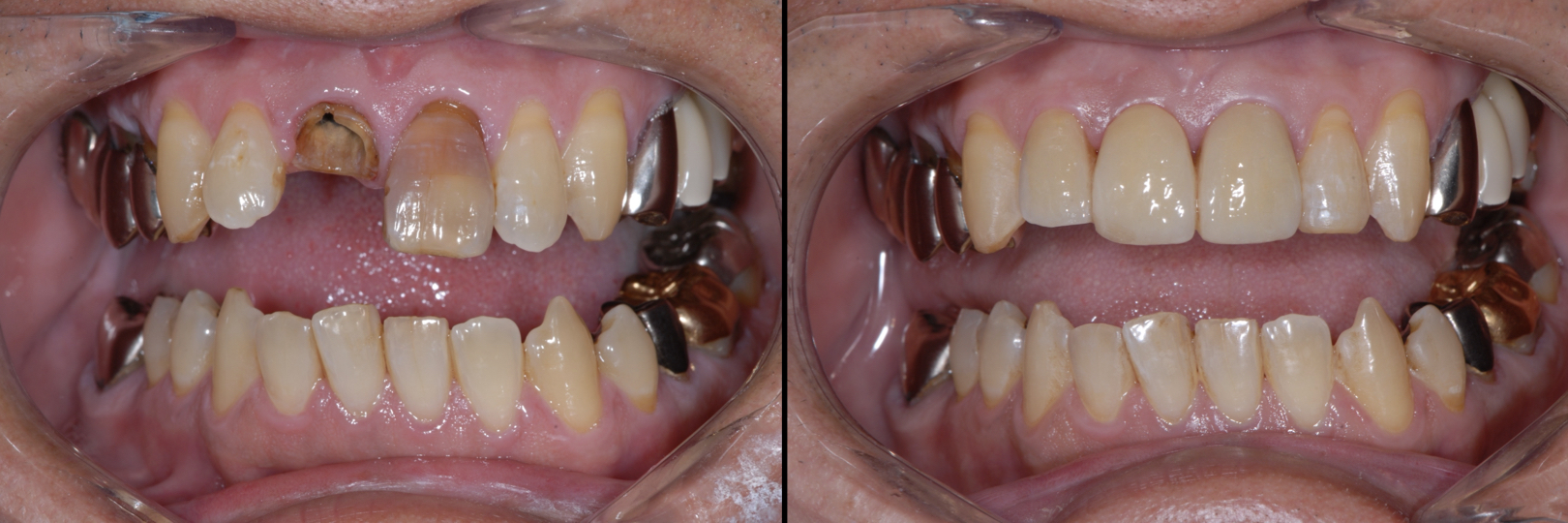 Before and After Image: Zirconia Bridge - front