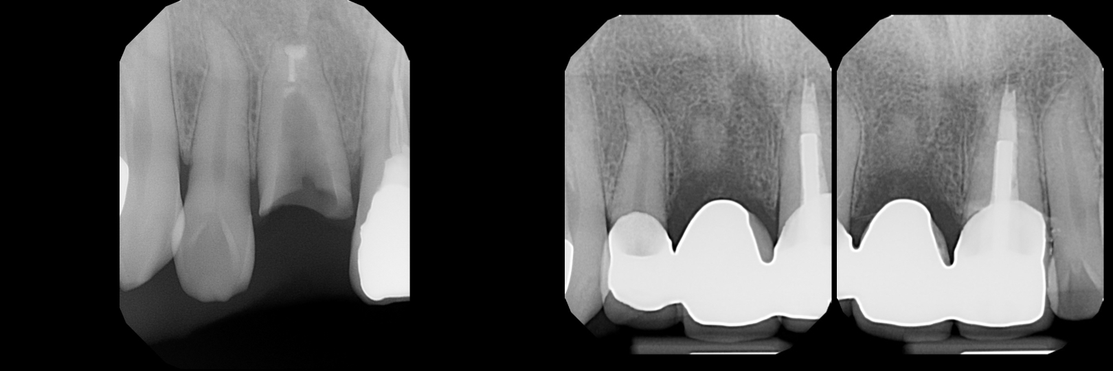 Before and After Image: Zirconia Bridge - front