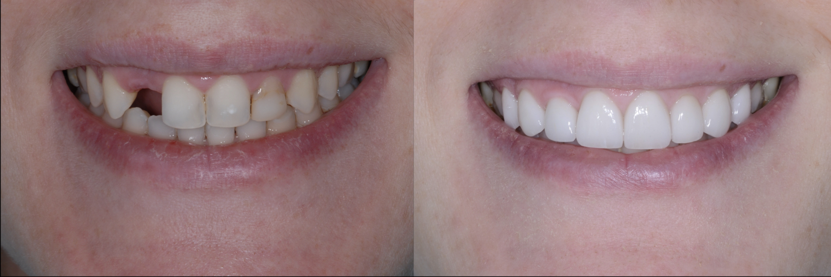 Before and After Image: Emax Veneers & Dental Implant - front