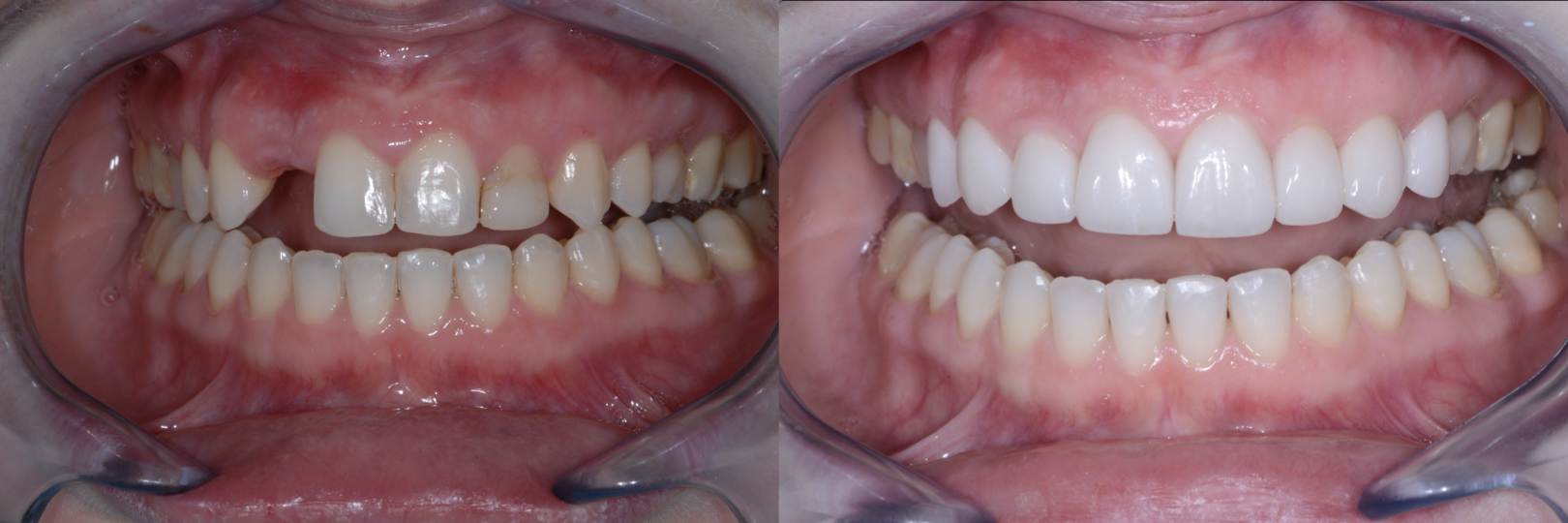 Before and After Image: Emax Veneers & Dental Implant - front