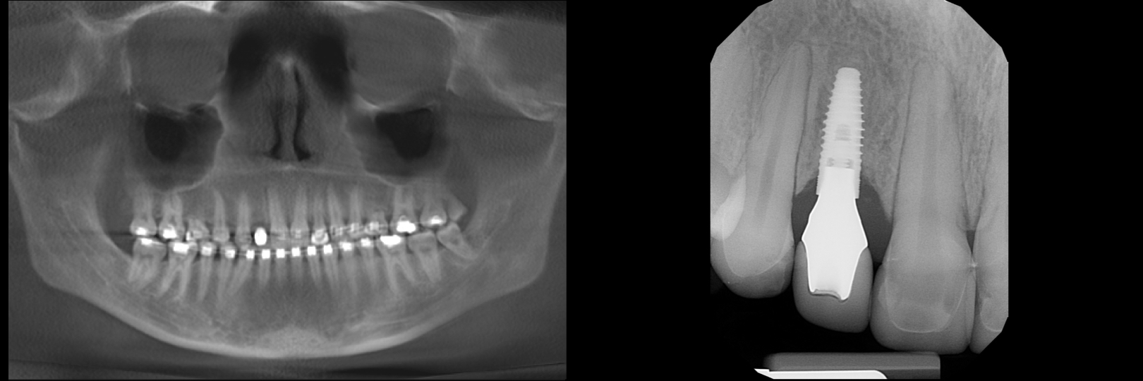 Before and After Image: Emax Veneers & Dental Implant - front