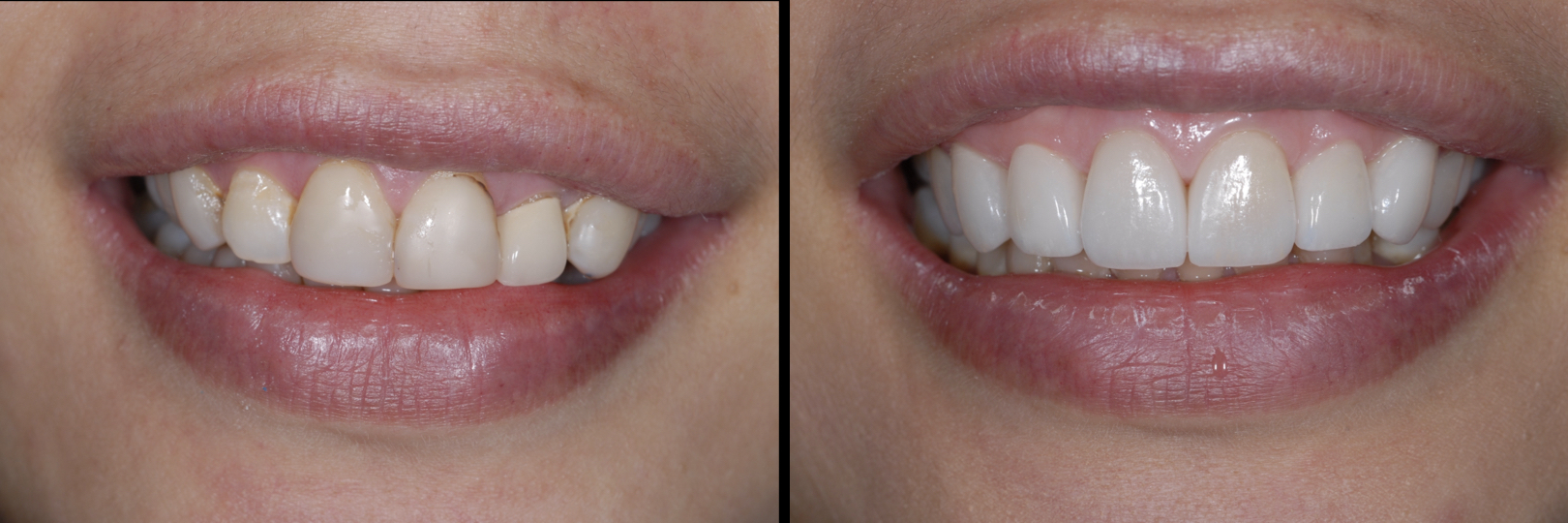 Before and After Image: Emax Veneers & Crown - front