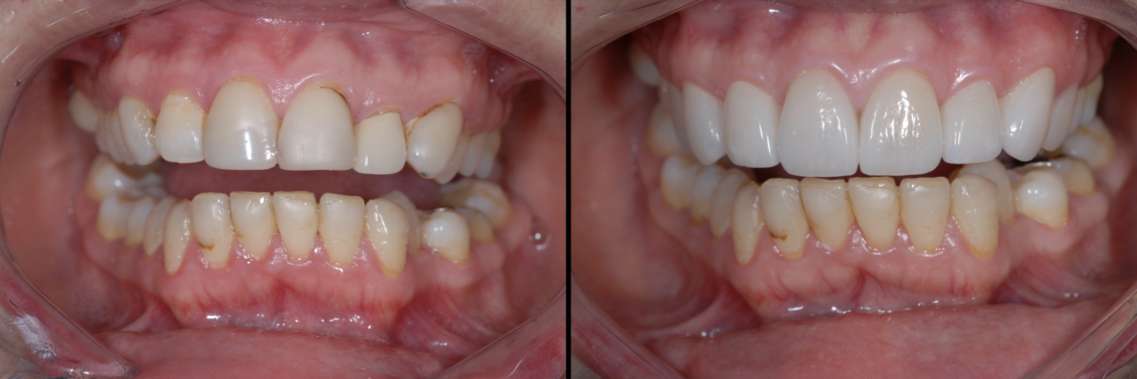 Before and After Image: Emax Veneers & Crown - front