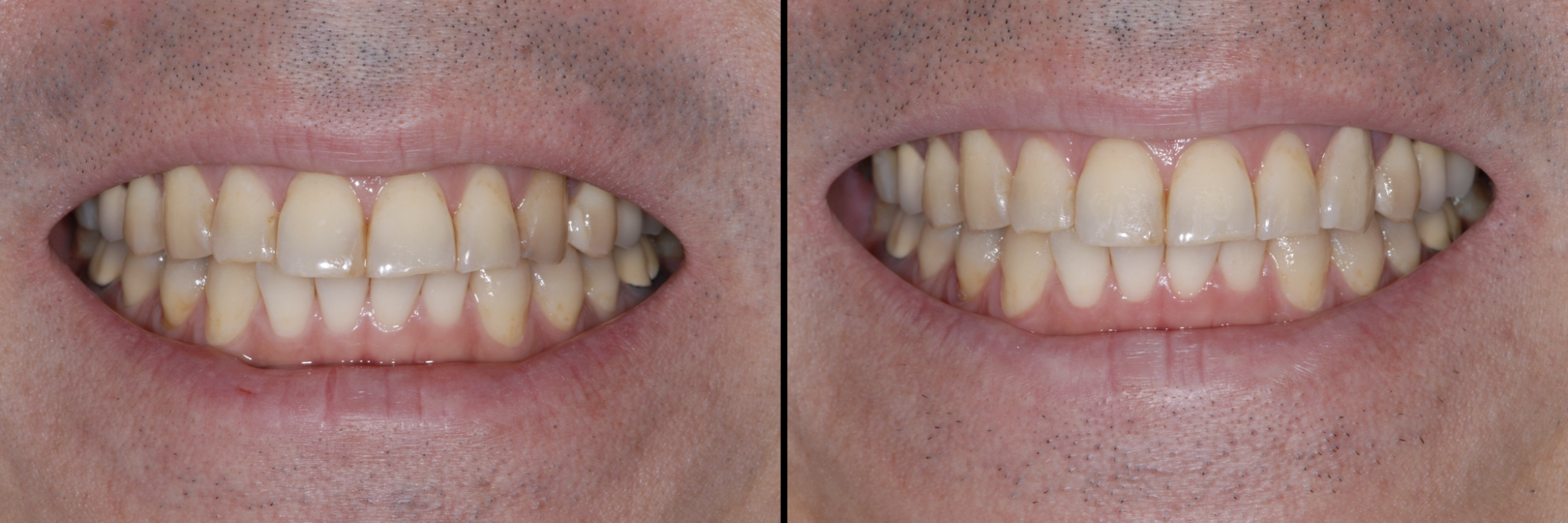 Before and After Image: Zirconia Crown - front