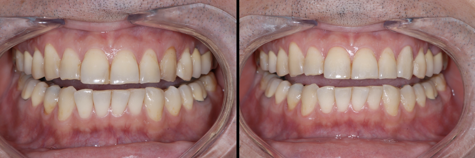 Before and After Image: Zirconia Crown - front
